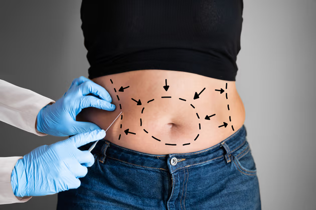 Türkiye’de Liposuction Yaptırmak: Klinik Seçimi, Süreç ve 2026 Rehberi